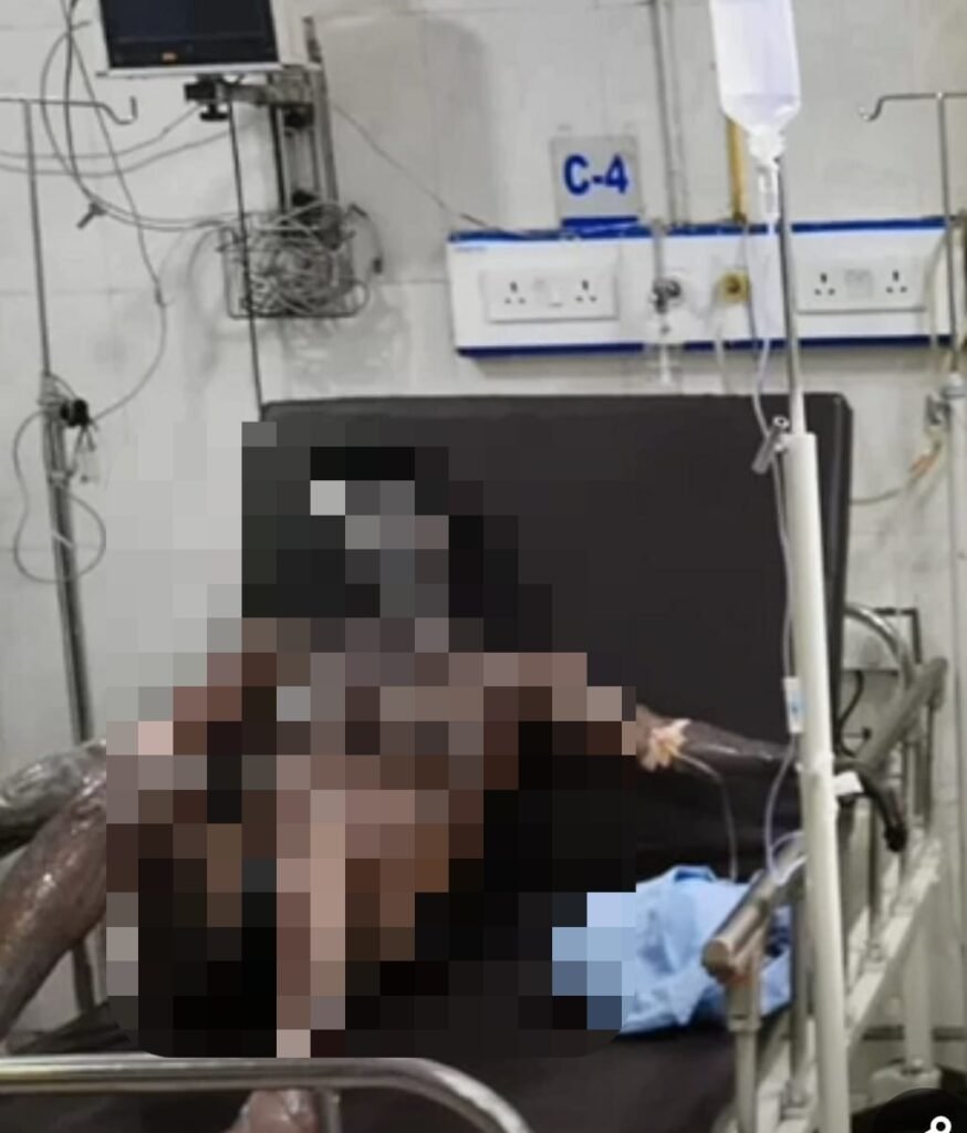 रामगढ़ की स्टील फैक्ट्री में फर्नेस ब्लास्ट, 10 से ज्यादा मजदूर झुलसे; 3 रांची रेफर